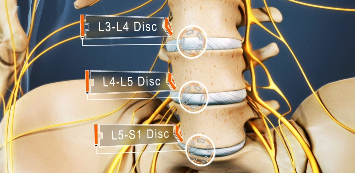Discos de la columna lumbar, que se ven afectados con mayor frecuencia en la osteocondrosis. 