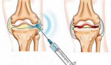 El bloqueo de la articulación de la rodilla para la artrosis