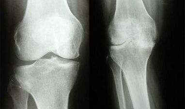 Métodos de diagnóstico de rodilla