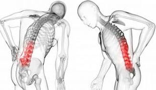 Hernia intervertebral complicación con osteocondrosis