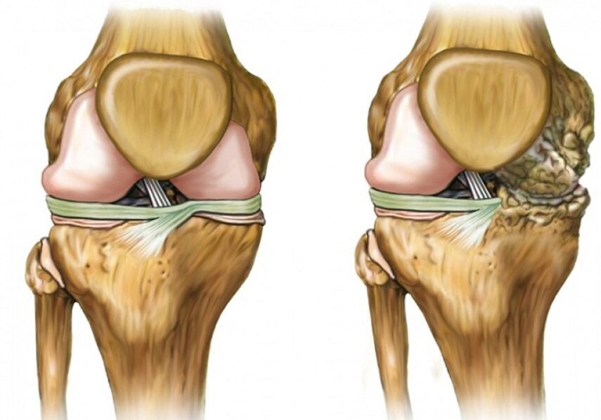 Artrosis de la rodilla