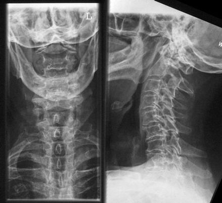 Cervical x -ray - método de diagnóstico de osteocondrosis
