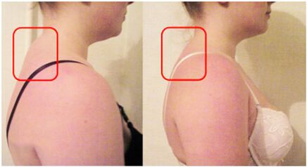 Formación de rodillo muscular con osteocondrosis cervical