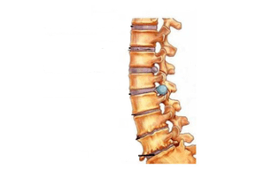 Daño a la columna con osteocondrosis cervical