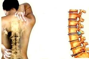 Dolor de espalda en diferentes etapas del desarrollo de la osteocondrosis cervical