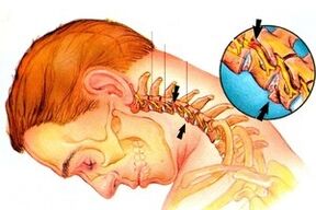pellizco del nervio en la columna con osteocondrosis cervical