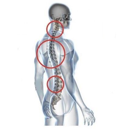 sitios de osteocondrosis espinal