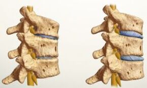 ¿Cómo se ve la osteocondrosis