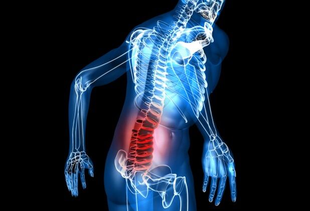 ¿Qué es la osteocondrosis lumbar